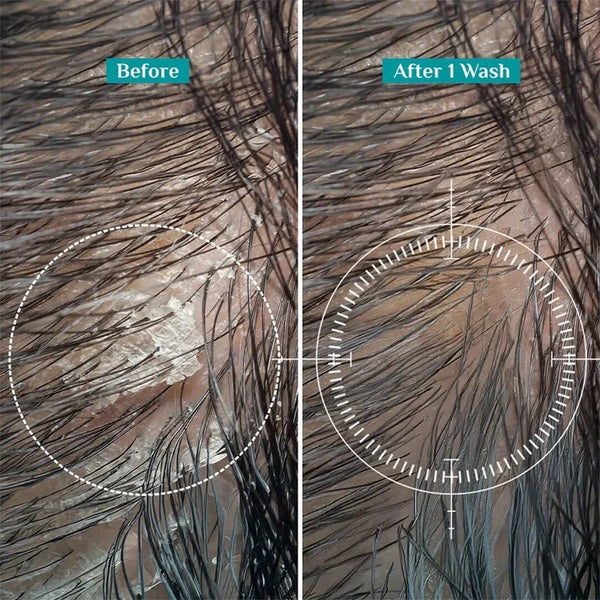 Pilgrim Australian Tea Tree Anti-Dandruff Shampoo With Salicylic Acid